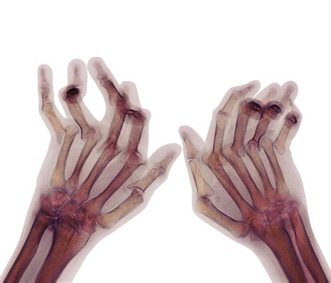 Arthritic Hands, X-ray Photograph by Cnri