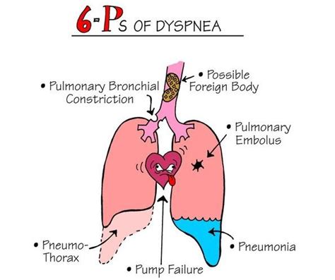 Dyspnea | Current Health Advice, Health Blog Articles and Tips