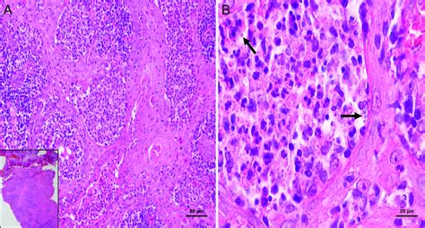 Histopathological aspects of mucosal leishmaniasis of the lower lip ...