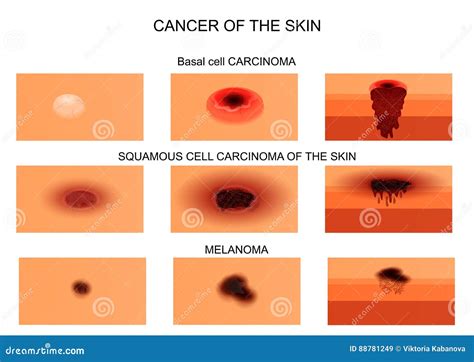 Images Of Different Types Of Skin Cancer