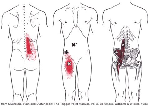 Psoas Syndrome - Overlooked Cause Of Back, Hip & Groin Pain