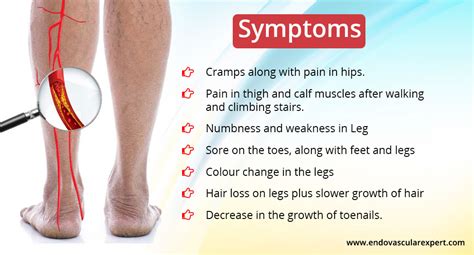 Peripheral Artery Disease Treatment in Jaipur by Dr. Nikhil Bansal