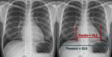 Chest X-ray Anatomy - Heart size and contours