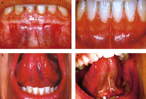 Absence of the inferior labial and lingual frenula in Ehlers-Danlos ...