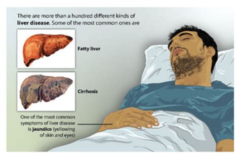 From fatty food to a sedentary lifestyle, all can contribute to liver ...