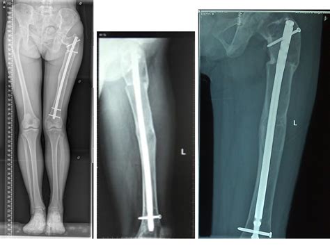 Figure 3 from Double-level osteotomy and one-stage reconstruction with ...