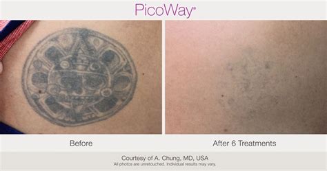 PicoWay Laser Tattoo Removal – Synergy Medical Aesthetics – Nanaimo ...