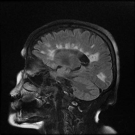 MRI Findings in Multiple Sclerosis - MEDizzy