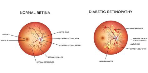 Stages of Diabetic Retinopathy