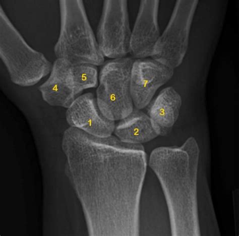 The X-ray image of carpal bones (Benoudina Samir, Radiopaedia.org, rID ...