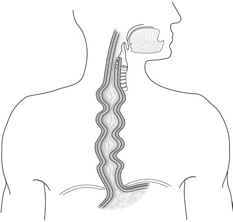 Diffuse Esophageal Spasm