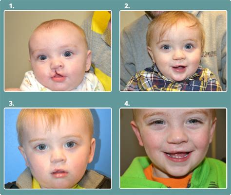 Before & After Cleft Lip & Palate - Michael Bateman, MD, PC