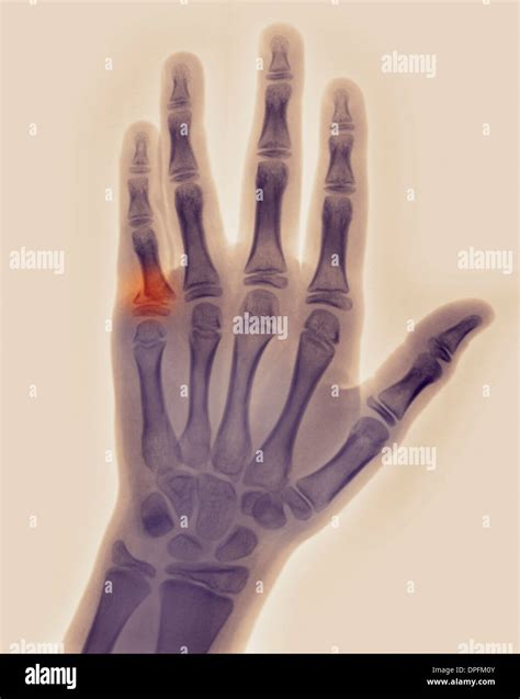 4th Proximal Phalanx Fracture