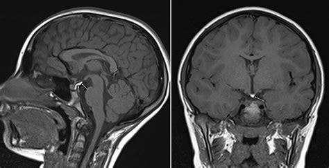 Pituitary Tumor Mri