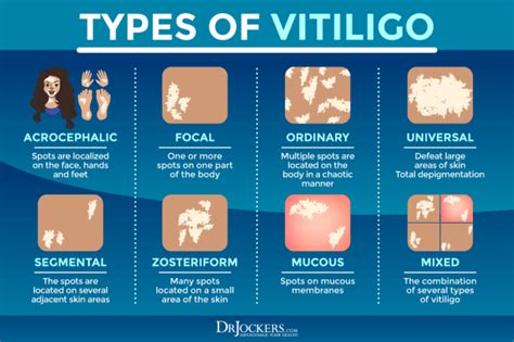 Vitiligo: Symptoms, Causes, and Support Strategies