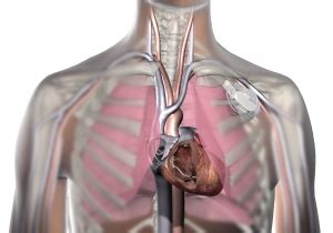 How are Pacemaker Leads Implanted? – Heart Rhythm Center