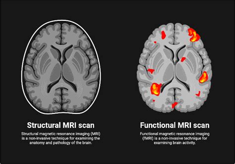 Difference Between MRI And FMRI, 50% OFF