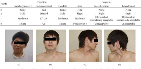 Figure 1 from A Surgical Treatment for Adult Muscular Torticollis ...