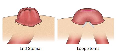 N308: GI Ostomy Care (Spring 2022) Flashcards | Quizlet