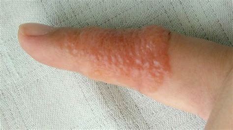 Dyshidrotic Eczema: Overview, Causes, Diagnosis & Pictures