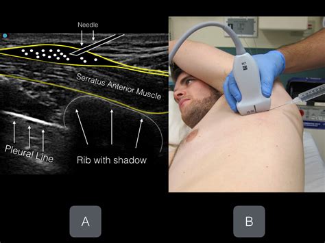 Serratus Anterior Plane (EASY) — Highland EM Ultrasound Fueled pain ...