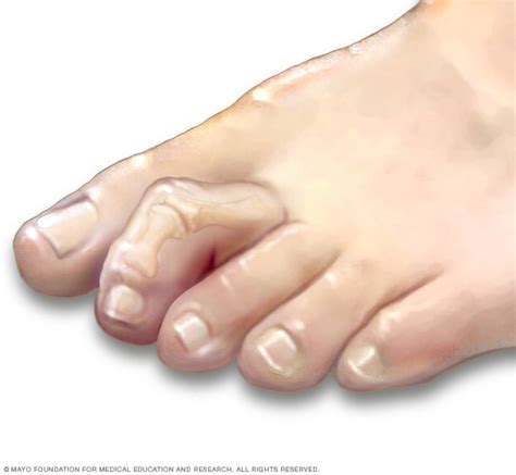 Hammertoe and mallet toe - Symptoms and causes - Mayo Clinic