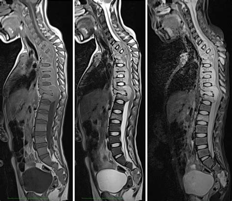 Disseminated tuberculosis – Radiology Cases