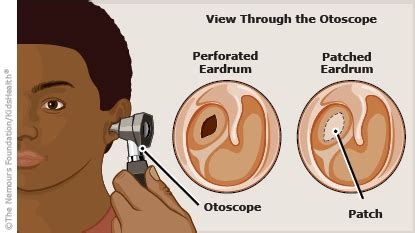 Tympanic Membrane Perforation Repair