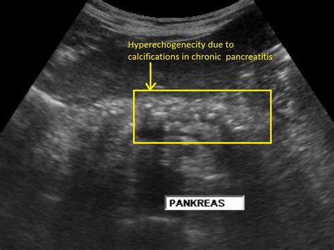 Chronic pancreatitis ultrasound - wikidoc