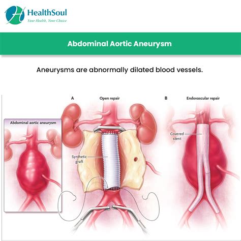 Abdominal Aortic Aneurysm Surgery: Indications and Risks – Healthsoul