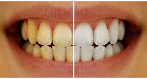 The Best 9 Tips to Prevent Yellow Teeth | Abbotsford Dental