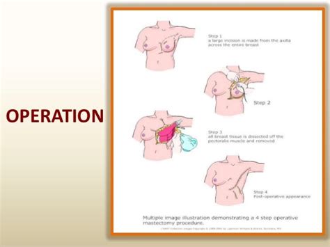 Mastectomy Anatomy