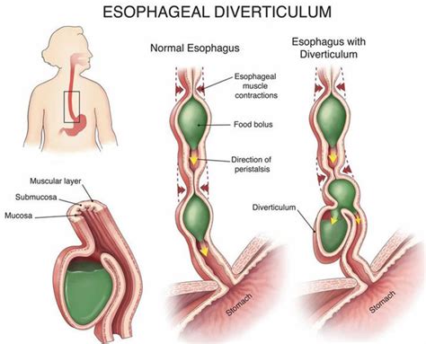 Esophageal diverticulum causes, types, symptoms, diagnosis & treatment