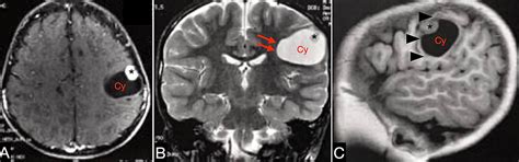 Pleomorphic Xanthoastrocytoma of the Frontal Lobe in a Child: A Rare ...