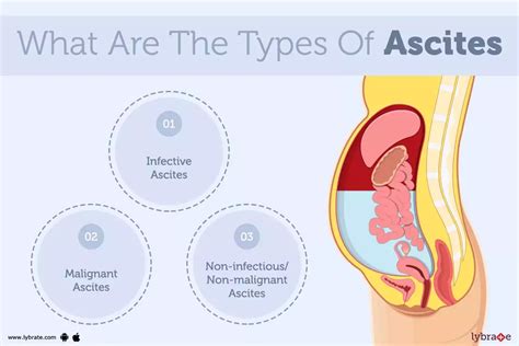 Ascites: Causes, Symptoms, Treatment and Cost