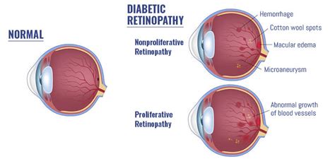 Diabetic Retinopathy Manhattan | Diabetic Eye Care NYC | Angioletti