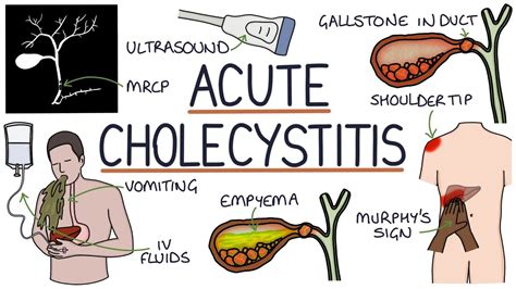 Understanding Acute Cholecystitis - YouTube