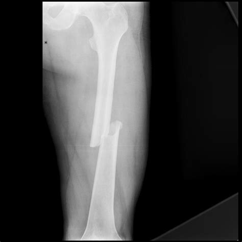 Oblique bone fracture - intseka