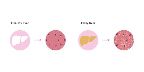 Fatty liver – Hepa-Merz