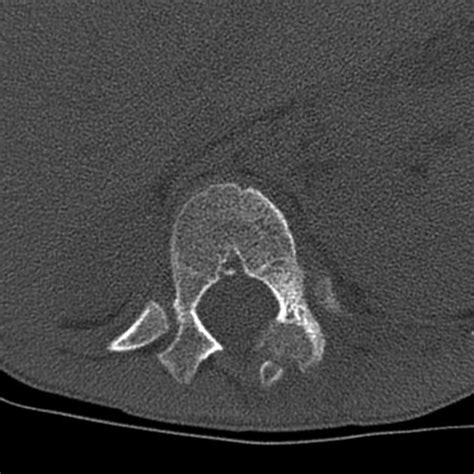 Osteoblastoma | Radiology Case | Radiopaedia.org | Radiology, Case ...