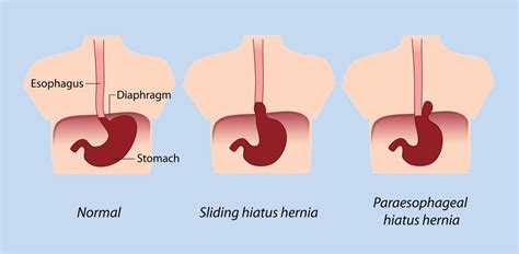 Upper Stomach Pain Drink | carfare.me 2019-2020