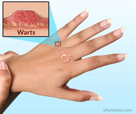 Warts|Causes|Symptoms|Investigations|Treatment-Conservative ...