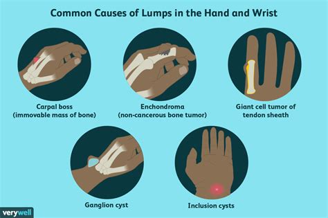 Causes of Lumps and Bumps on the Hands and Wrists