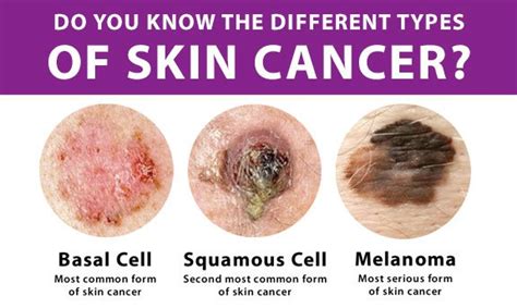 Types of skin cancer - Your Great Skin