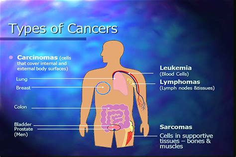 Blood Cancer Types