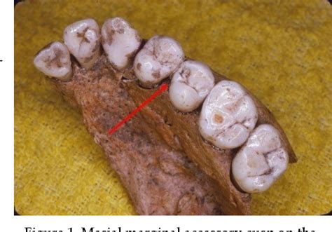 Figure 1 from Global Distribution of Marginal Accessory Cusps of the ...