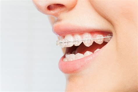 Everything You Need to Know About Clear Bracket Braces