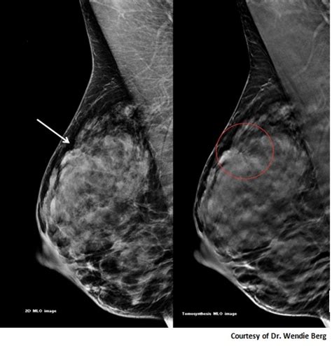 3D Mammography, Tomosynthesis, Diagnostic Mammogram | DenseBreast-info