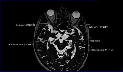 Cranial Nerves Mri