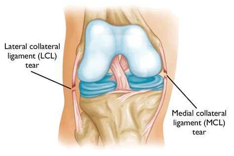 Common Knee Injuries - OrthoInfo - AAOS